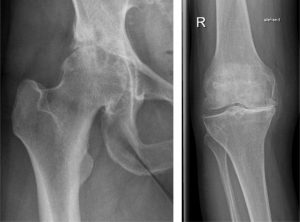 Arthrose Hüftgelenk und Kniegelenk