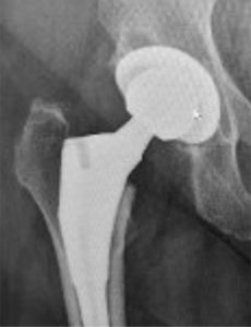 Orthopäde Stuttgart Hüftoperation