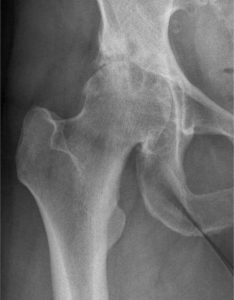 Orthopäde Stuttgart Hüftoperation