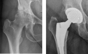 Orthopäde Stuttgart Hüftgelenk