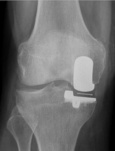 Knie-mediale Schlittenprothese Teilgelenk