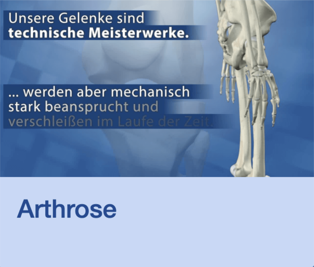 Video Arthrose Stuttgart