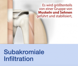 Video Subakromiale Infiltration Stuttgart